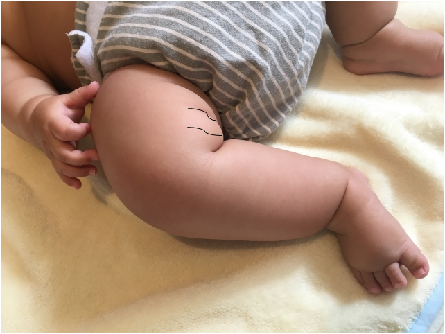 赤ちゃんの先天性股関節脱臼の予後と歩き方 生後1年3ヶ月の体験談 娘が診断を受けて 現在 Tarmiyan Blog